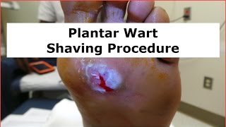 Plantar Wart Shaving Procedure [upl. by Rozanna]