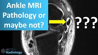 Fluid around posterior tibial tendon on ankle MRI  clinical relevance [upl. by Hamirak]