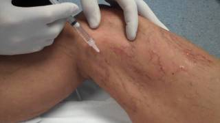 Sclerotherapy  The Vein Centre  Dr Richard Murbach  Treatment for Spider Veins [upl. by Ernestus]