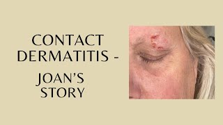 Contact Dermatitis  Joans Story [upl. by Yann]