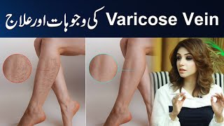 Varicose vein Reasons and Treatment  Dr Sahar Chawla [upl. by Adnahsed]