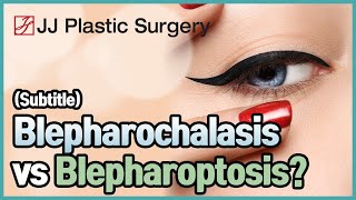 Blepharochalasis vs Blepharoptosis [upl. by Sixla]