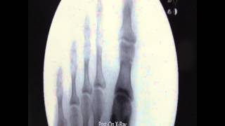 Bilateral Akin Osteotomy Hammertoe Correction With XRays [upl. by Annatsirhc]