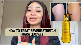 HOW TO GET RID OF STRETCH MARKS amp SCARS FAST  Treat severe Stretch mark with Grerivian Solution [upl. by Alyakcm]