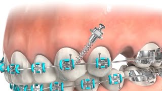 TADs Miniscrews  Orthodontic Appliance teeth dentist braces TADs miniscrew [upl. by Htebazile]