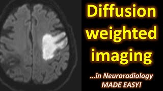 Diffusion Weighted Imaging DWI in Neuroradiology made easy [upl. by Iveel]