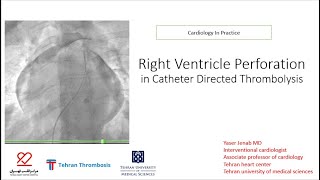 Right ventricle perforation in catheter directed thrombolysis CDT of pulmonary artery [upl. by Nesyla16]