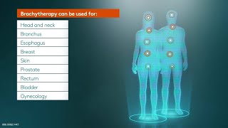 Brachytherapy an indispensable part of radiation therapy [upl. by Olive]