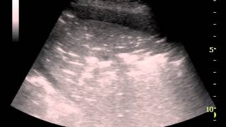 Addensamenti polmonari in corso di edema polmonare acuto cardiogeno emergency ultrasound [upl. by Harbot707]