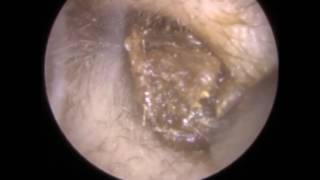 181 Ear Wax Teased amp Wriggled out to reveal Retracted Eardrum  Mr Neel Raithatha THC [upl. by Pax189]