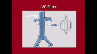 Management of DVTPulmonary Embolus [upl. by Drofhsa]