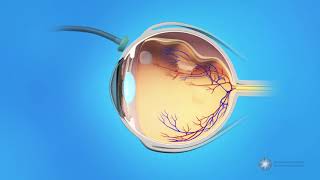 Vitrectomy Surgery for Detached Retina [upl. by Gaskill41]