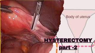 PART  2  NURSING CARE PLAN OF HYSTERECTOMY POST OPERATIVE MANAGEMENT GYNECOLOGICAL NURSING [upl. by Ansel]