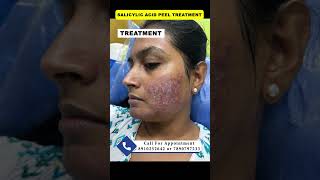 Salicylic acid peel  chemical peel  pimple peeling acne peel druttamkumarlenka acnetreament [upl. by Ettenay850]