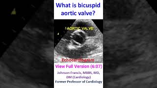 What is bicuspid aortic valve [upl. by Brentt]