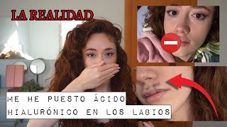 Me puse ÁCIDO HIALURÓNICO en LOS LABIOS y te cuento TODA LA VERDAD 🤐 ¿Salió mal [upl. by Nwahsaj]