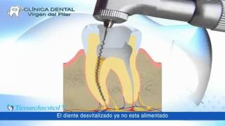 Dolor de muelas y dientes la corona por Clínica Dental Virgen del Pilar [upl. by Nettie]