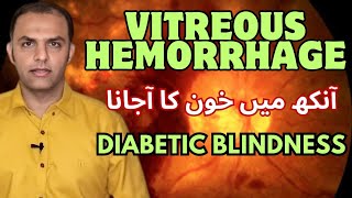 Diabetic Vitreous Hemorrhage and Treatment  Dr Faisal Anwar drfaisalanwar diabeticretinopathy [upl. by Kristofor]