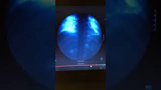 Diaphragm movement under fluoroscopy [upl. by Acinnod]