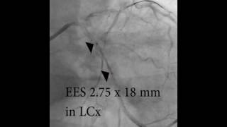 Using Scoring balloon in ostial LAD [upl. by Limbert]