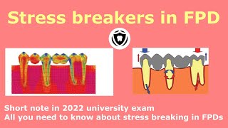 Stress Breakers in FPD [upl. by Nara]