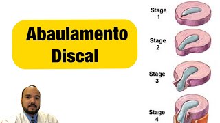 Abaulamento Discal  o que é [upl. by Hanover]