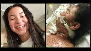 LA teenager’s skin melts’ off in severe reaction to prescription medication with strict FDA warning [upl. by Elumas]