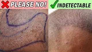 BUZZ Cut after Hair Transplant WATCH THIS FIRST [upl. by Anawat623]