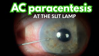 Anterior Chamber Paracentesis  HOW TO to quickly and safely lower elevated eye pressure [upl. by Walli]