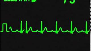 Bloqueo Auriculoventricular de 1er Grado  AV Block 1st degree [upl. by Coulter]