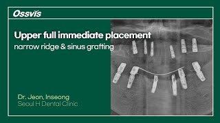 Clinical Case Upper full immediate placement on narrow ridge amp sinus grafting [upl. by Lleroj]