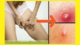 How to Get Rid of Boils on the Bum amp Thighs [upl. by Eletnahs779]