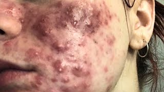 cystic acne blackhead whitehead removal  Relaxing Spa Acne Treatment [upl. by Eiramrebma468]