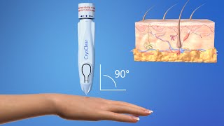 CryoConcepts  CryoClear Device  3D Medical Animation [upl. by Alat]