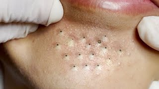 Big Cystic Acne Blackheads Extraction Blackheads amp Milia Whiteheads Removal Pimple Popping  1894 [upl. by Hallutama]