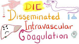 Disseminated Intravascular Coagulation DIC [upl. by Inanuah431]