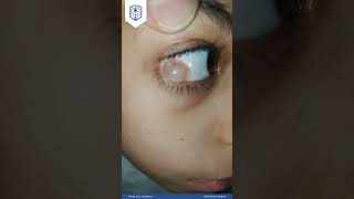 Educational Video 22 Conjunctival cyst by AEA [upl. by Capello341]