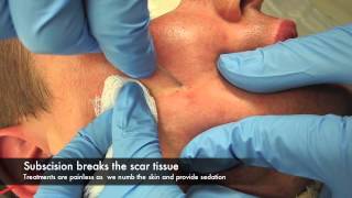 Subscision and surgery for acne scars [upl. by Winsor]