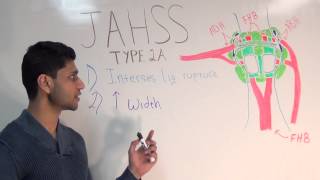 Jahss 1st MTP Dislocation  Anatomy and Biomechanics [upl. by Bhayani]