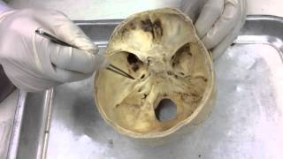 Gross Anat for Dent  Meninges intradural venous sinuses amp cranial fossae [upl. by Estevan]