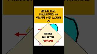 ROPLAS TEST dacryocystitis opthalmology [upl. by Irak]