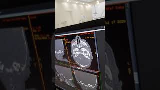 Case 181 bilateral bony choanal atresia to RO CHARGE Syndromecolobom heart atresia retardation [upl. by Leuas]