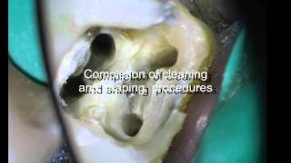 PeriodontalEndodontic considerations [upl. by Dnarb994]