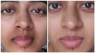 How I ACTUALLY got Rid of Pigmentation Around my Mouth  Pigmentation Treatment For Mouth Darkness [upl. by Nnayllek]