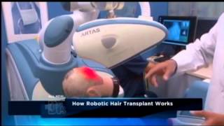 Robotic Hair Transplant Surgery  ARTAS Hair Restoration [upl. by Enwahs721]