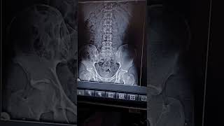 xray KUB x ray kaise hota hai x ray q karte hai radiologytechnologist ct scan kaise hota hai [upl. by Ricarda130]