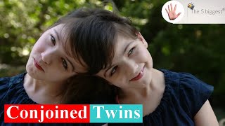 Conjoined Twins Top 10 Facts You 🅳🅾🅽🆃 Need to Know  Body Bizarre [upl. by Brenna]