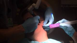 Keloid Laser Removal [upl. by Aig938]