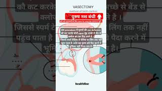 पुरुष की नसबंदीvasectomy shourtviralwowtrendinganatomyphysiology [upl. by Poore]