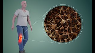 Generalidades de Osteoporosis parte 1 Epidemiología y nociones de genética [upl. by Schumer952]